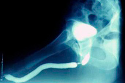 Bulbar stricture image