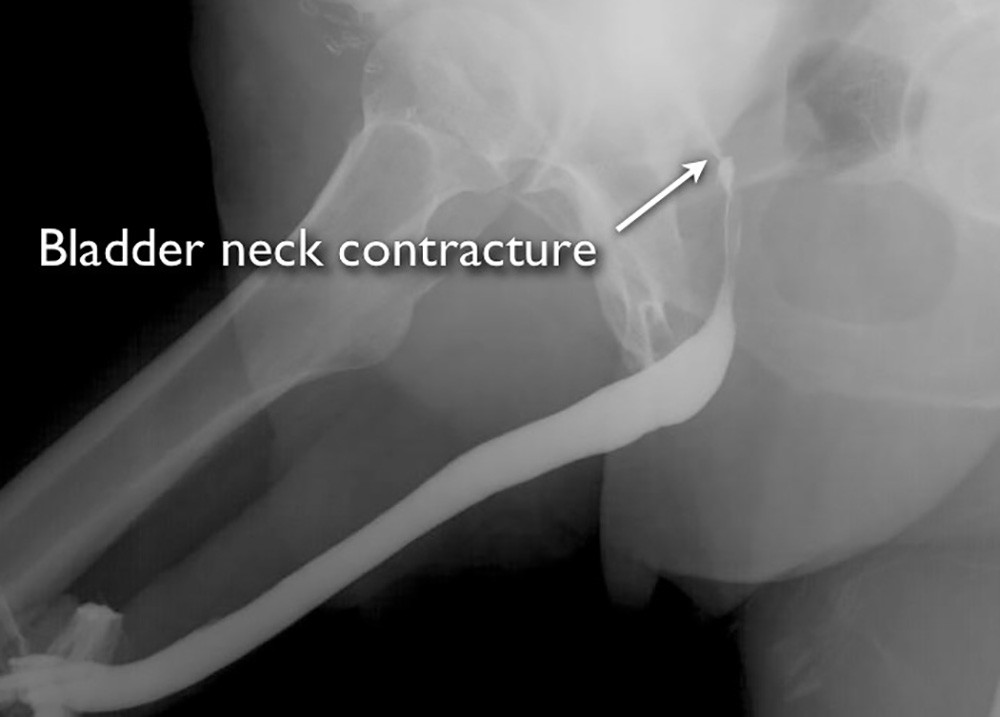 bladder neck cancer treatment