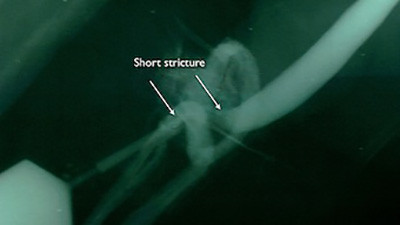 BXO short stricture
