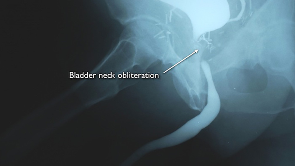 Bladder neck obliteration