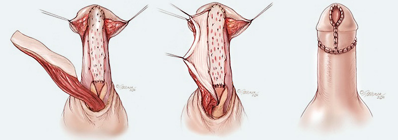Flap graft urethroplasty