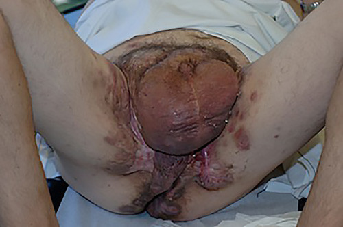 Hidradenitis scrotum