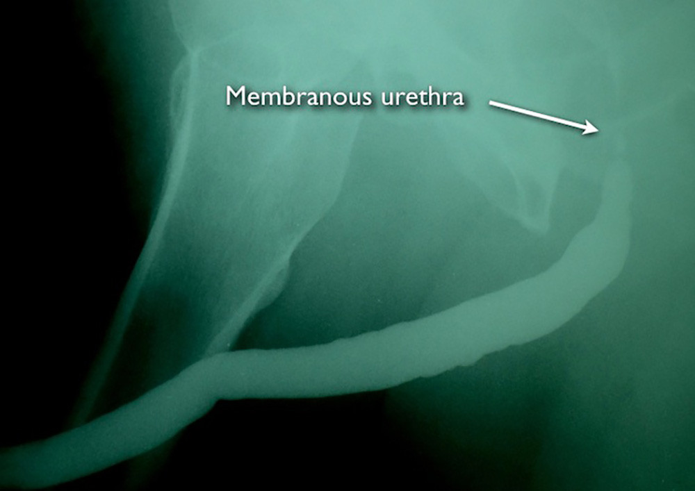 RUG membranous stricture
