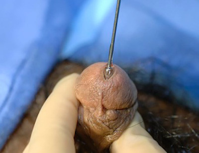 Bougie urethra calibration
