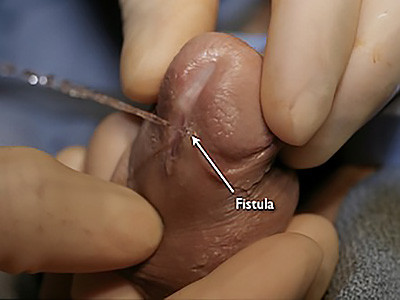 Hypospadias fistula