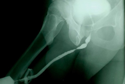 Healed urethra image