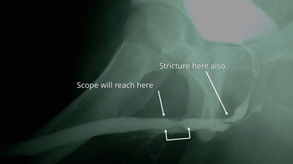Retrograde urethrogram rug image indicating scope pathway to urethral stricture