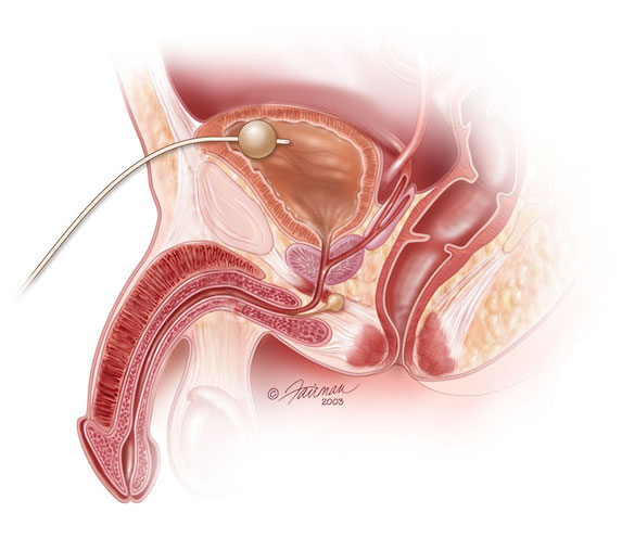 Medical illustration of a suprapubic tube inserted in bladder