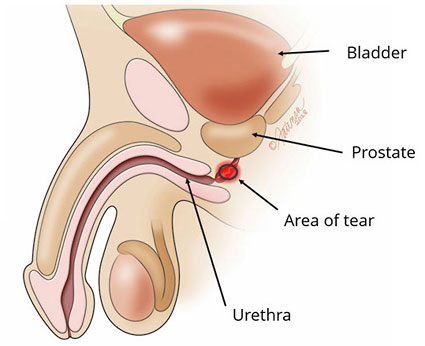 Medical illustration of urethral tear