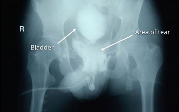 Retrograde urethrogram after a pelvic trauma showing a urethral tear