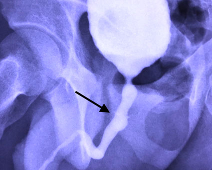 Retrograde urethrogram after surgery to repair pelvic fracture urethral injury