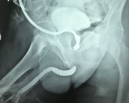 Retrograde urethrogram prior to surgery to repair pelvic fracture urethral injury
