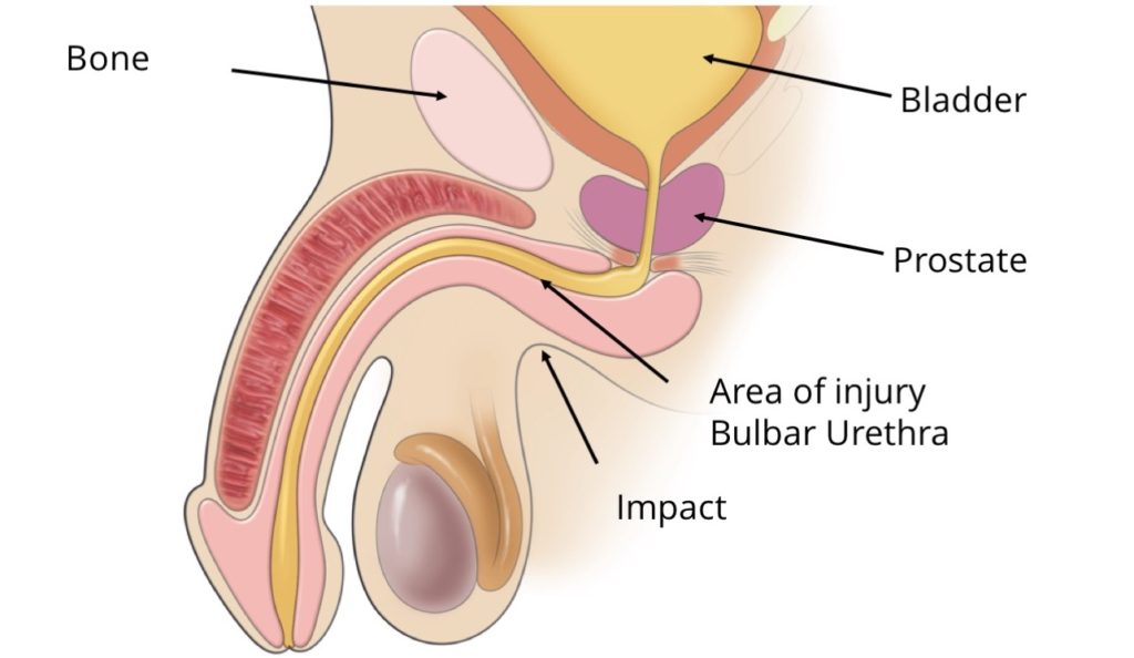 Bulbar Urethral Stricture